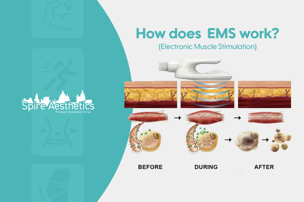 EMS treatment for post pregnancy weight loss treatment Middlesex