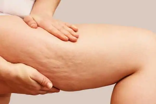 Image of woman showing leg with cellulite Middlesex
