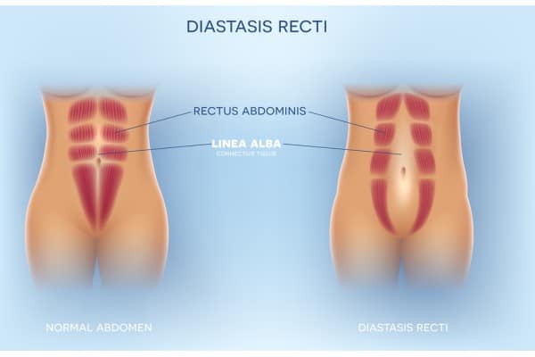 What Non-Surgical Options Are Available for Diastasis Recti Middlesex?