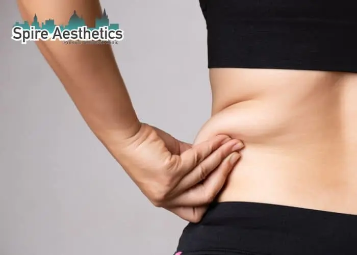 Image of woman pinching fat on their hips Middlesex. Fat Freezing treatment