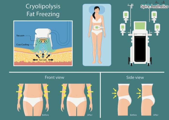 Image of diet and fat freezing combined for best results for Spire Aesthetics Middlesex
