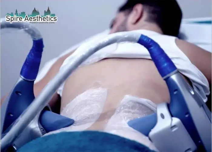 Man having fat freezing treatment done on love handles before a competitions Middlesex to create a sculpted look.