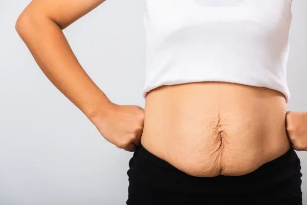 Image of a woman's stomach after weight loss with sagging skin following a gastric band Middlesex