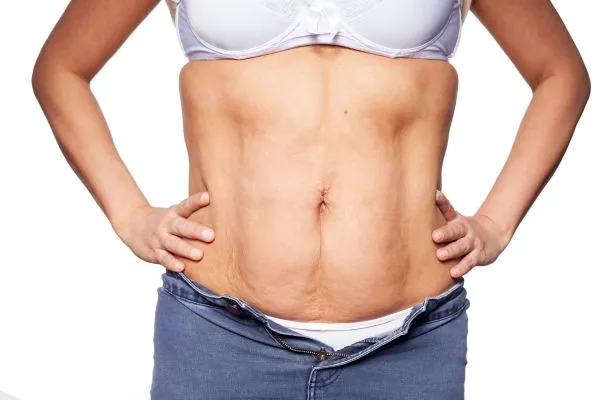 sagging skin on woman's stomach after weight loss injections Middlesex