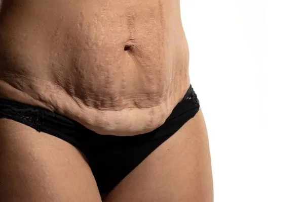 Image of womans stomach after weight loss injections Middlesex showing saggy skin