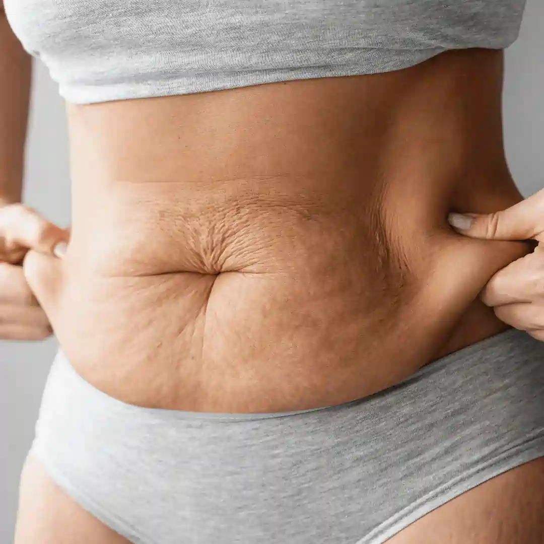 Is It Normal to Have Loose Skin After Pregnancy Middlesex?
