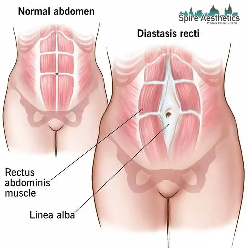 When Will My Belly Feel Normal Again Middlesex?