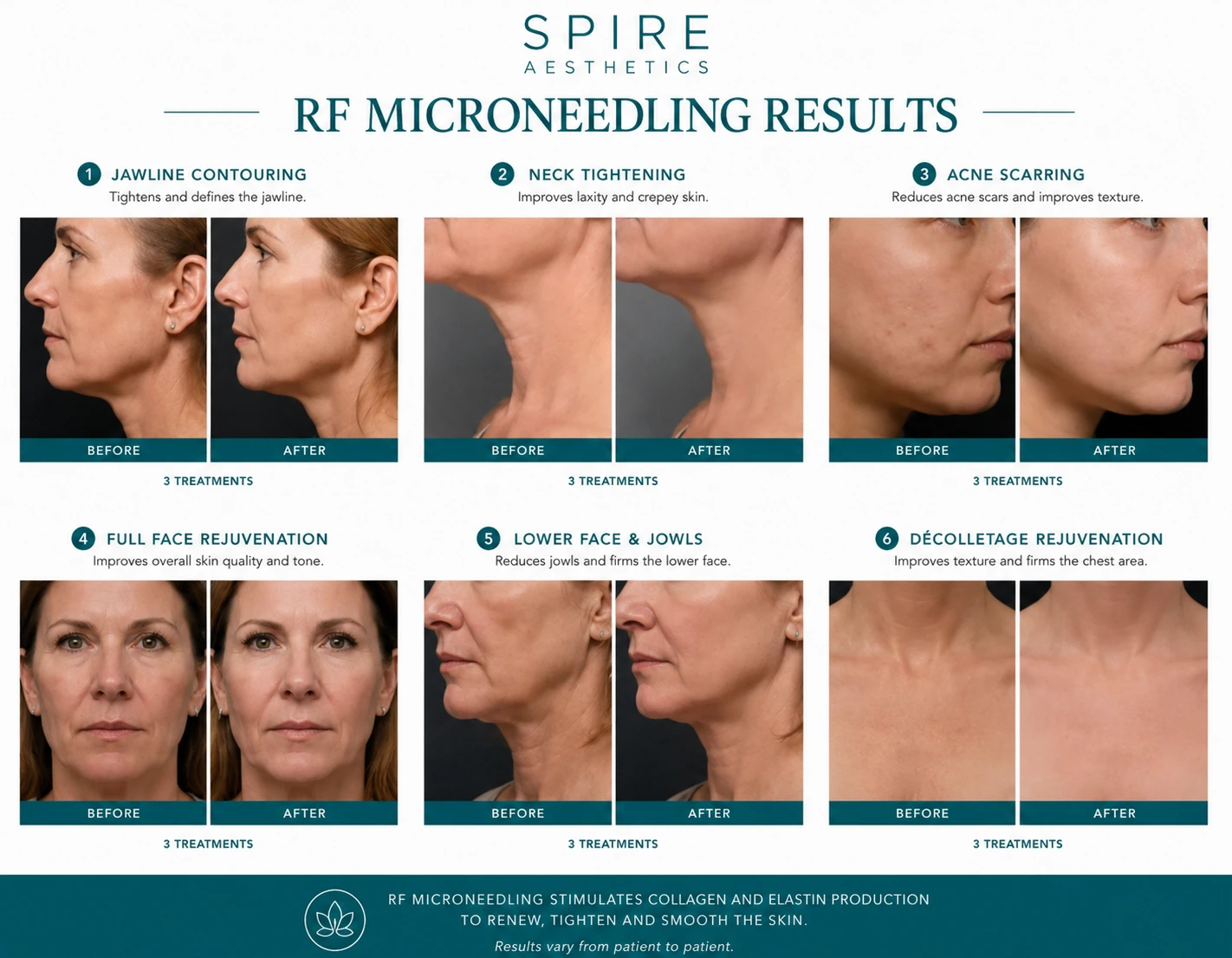 RF Microneedling Skin tightening Middlesex results