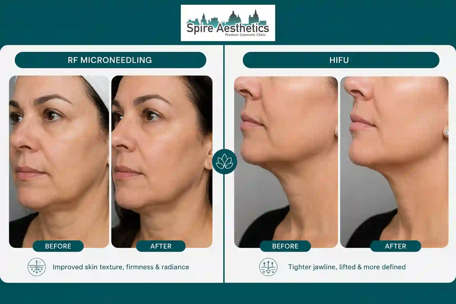 Can RF Microneedling and HIFU Be Combined Middlesex?