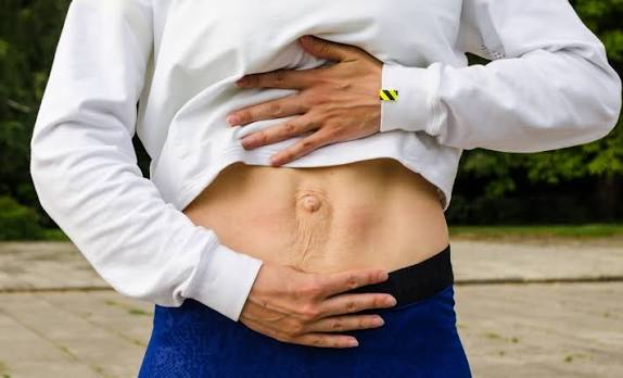 When Could Diastasis Recti Be the Missing Piece of the Puzzle Middlesex?