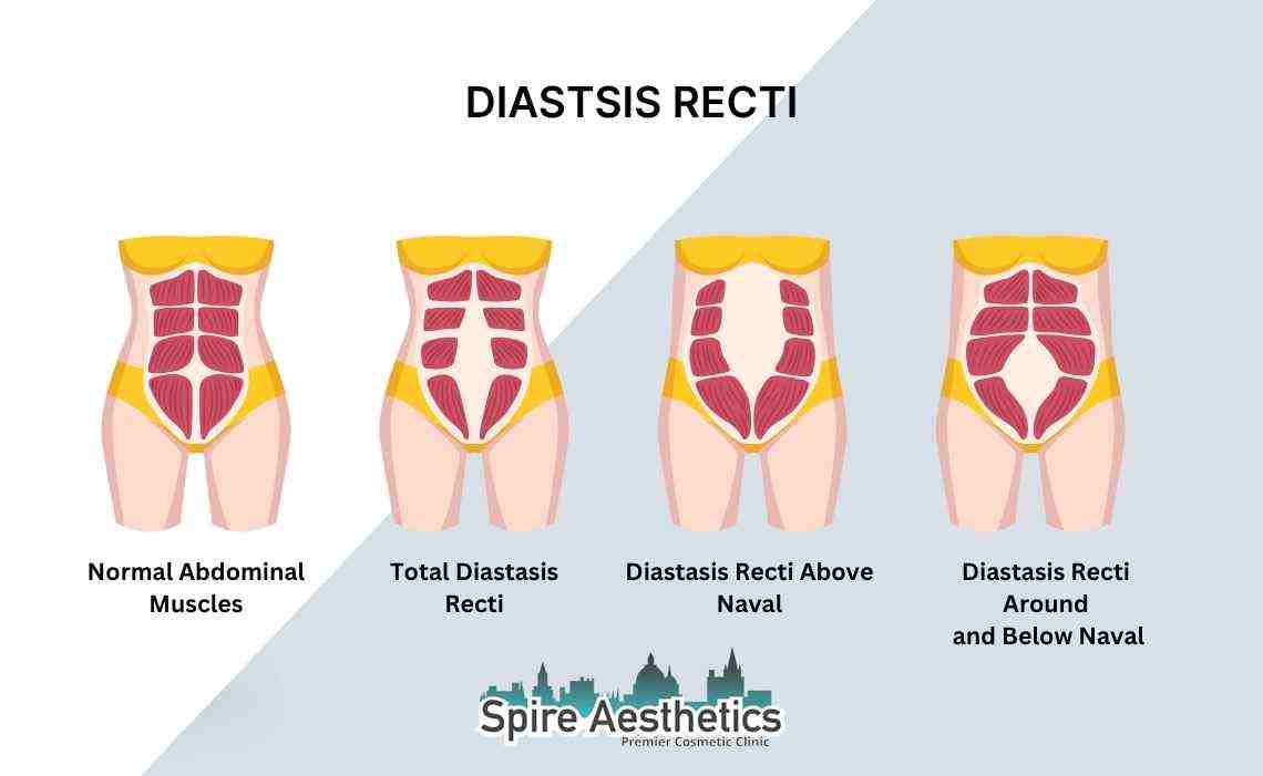 Is Non-Surgical Diastasis Recti Treatment Right for You? Common Concerns Answered Middlesex